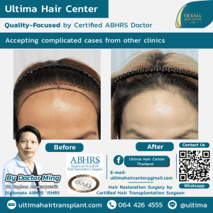 Why is hair transplant in Thailand often more affordable