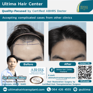 Are Thai Hair Transplant Surgeons Properly Certified and Experienced?