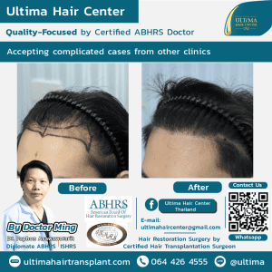 What Factors Influence the Total Cost of a Hair Transplant