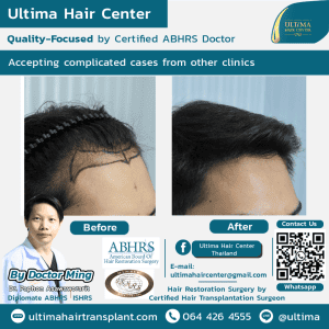 Medical tourism Thailand for hair transplant