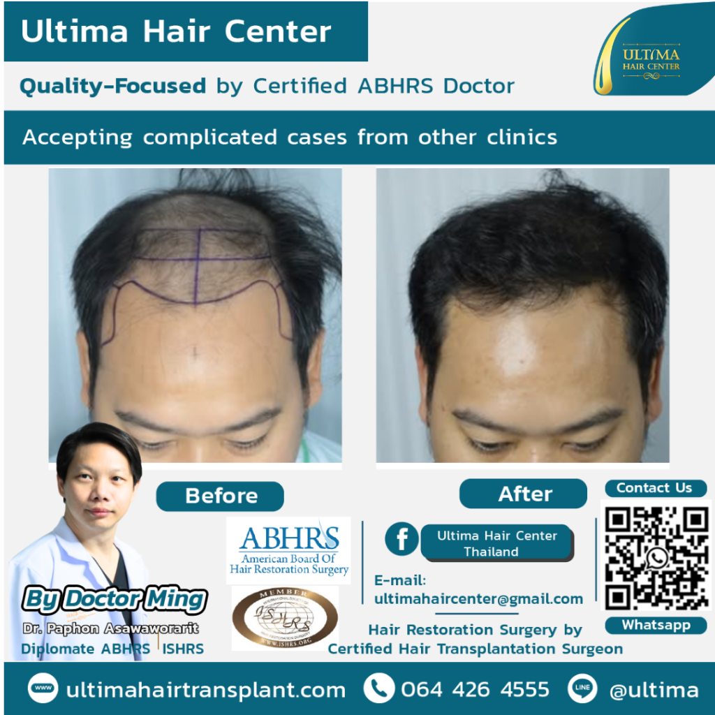 Hair transplant Thailand