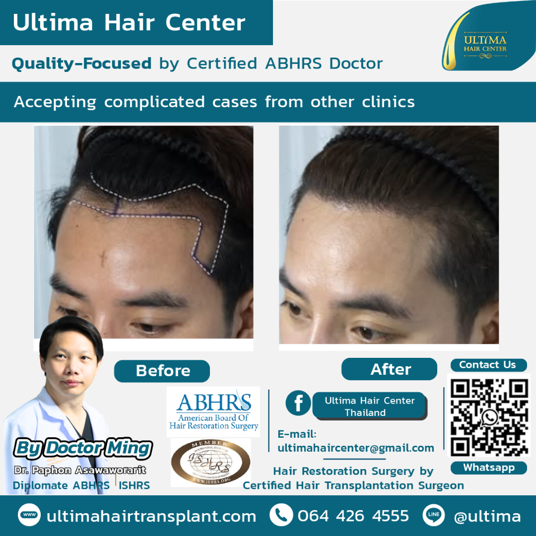 Hair transplant Thailand