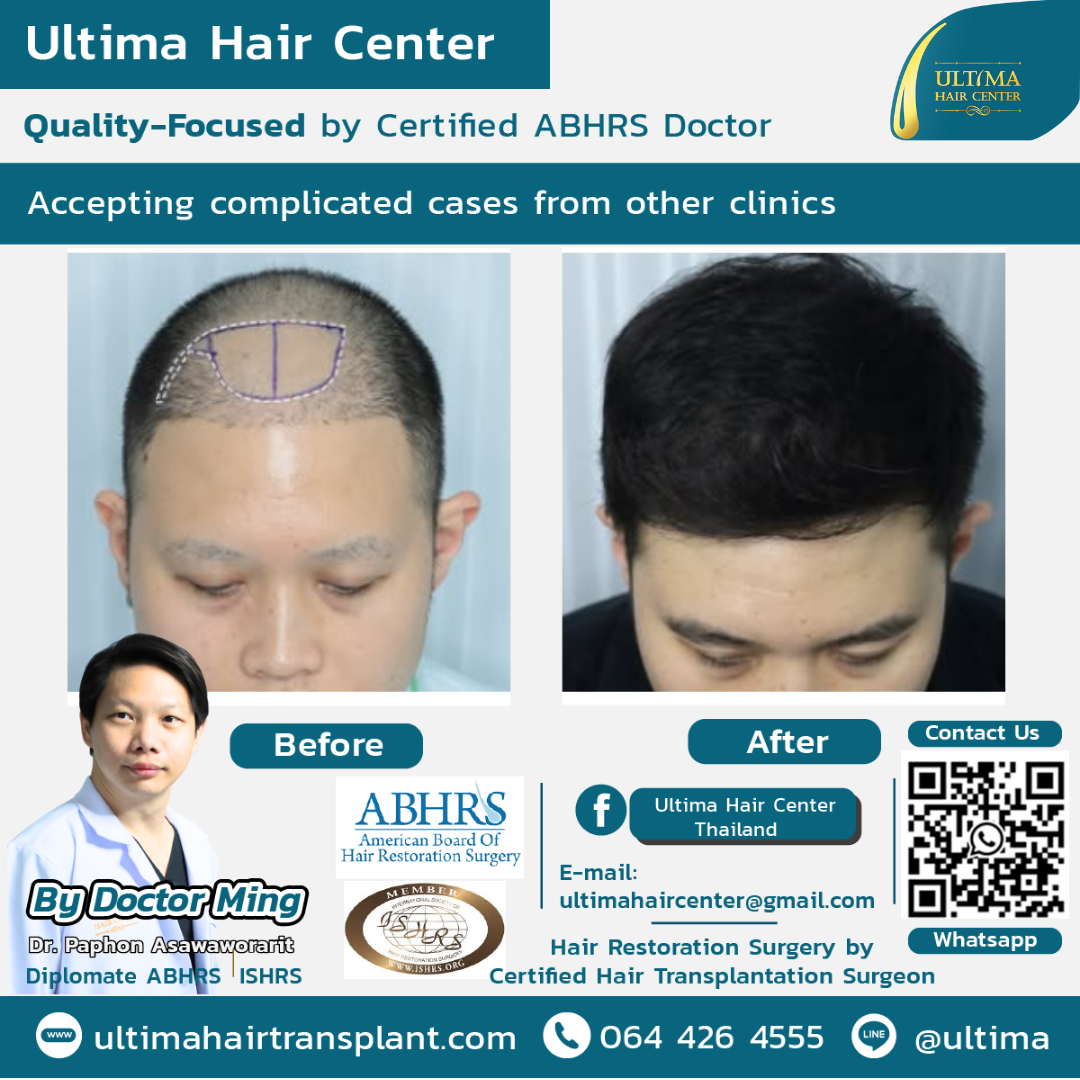 Hair transplant Thailand