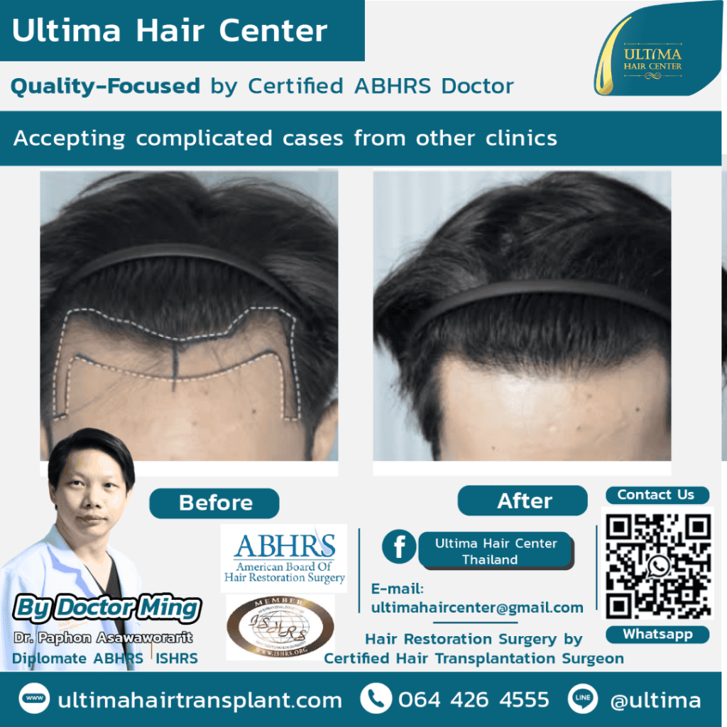 Hair transplant in bangkok thailand