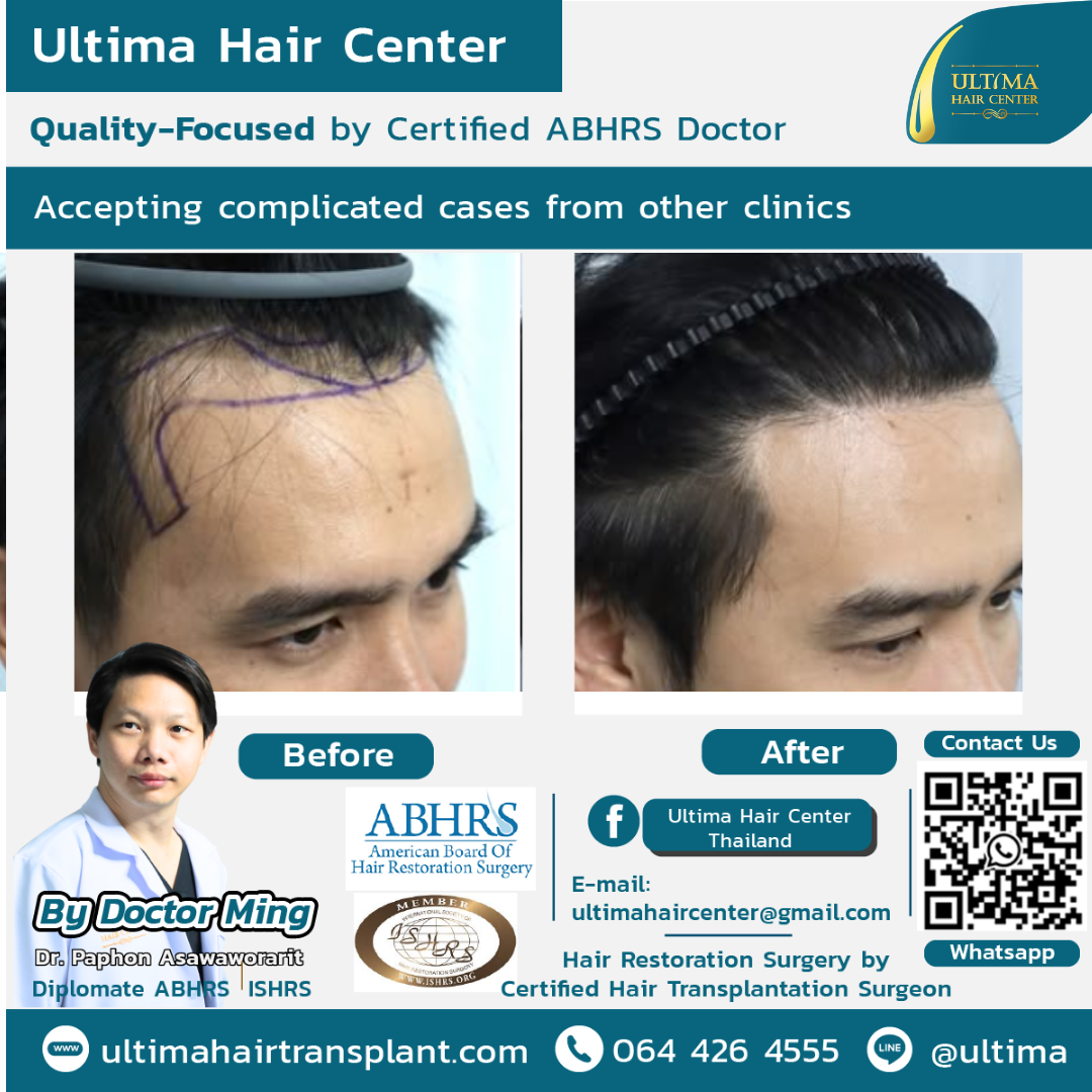 Is Thailand Good for Hair Transplants