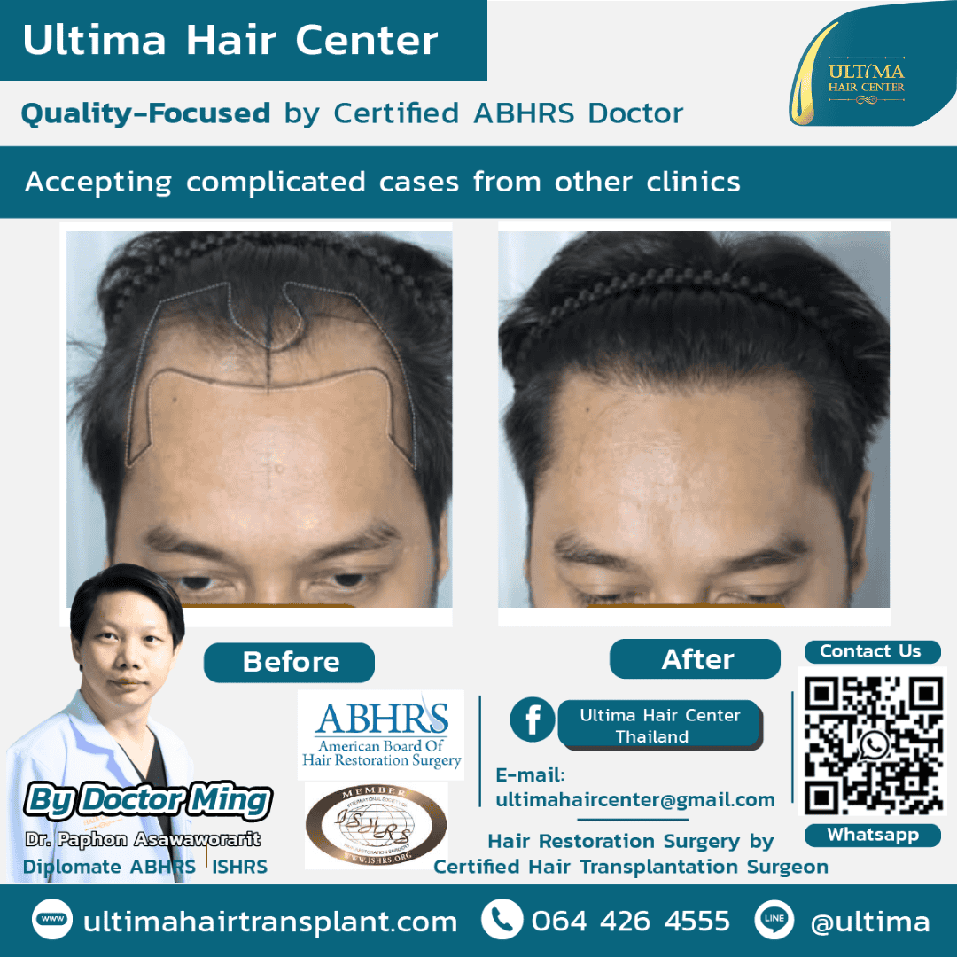 Board Certified Hair Transplant Reviews