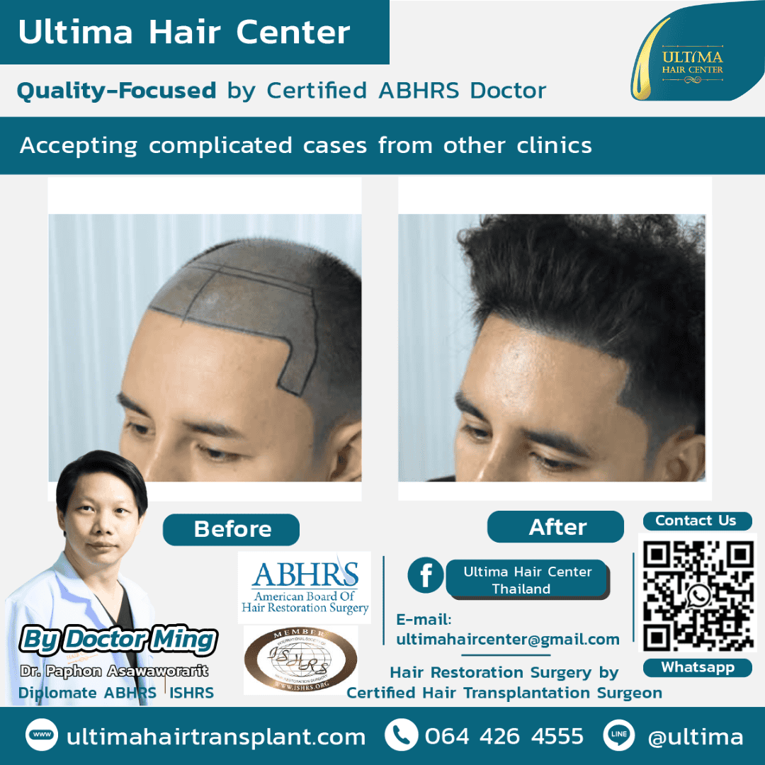 Board Certified Hair Transplant Reviews