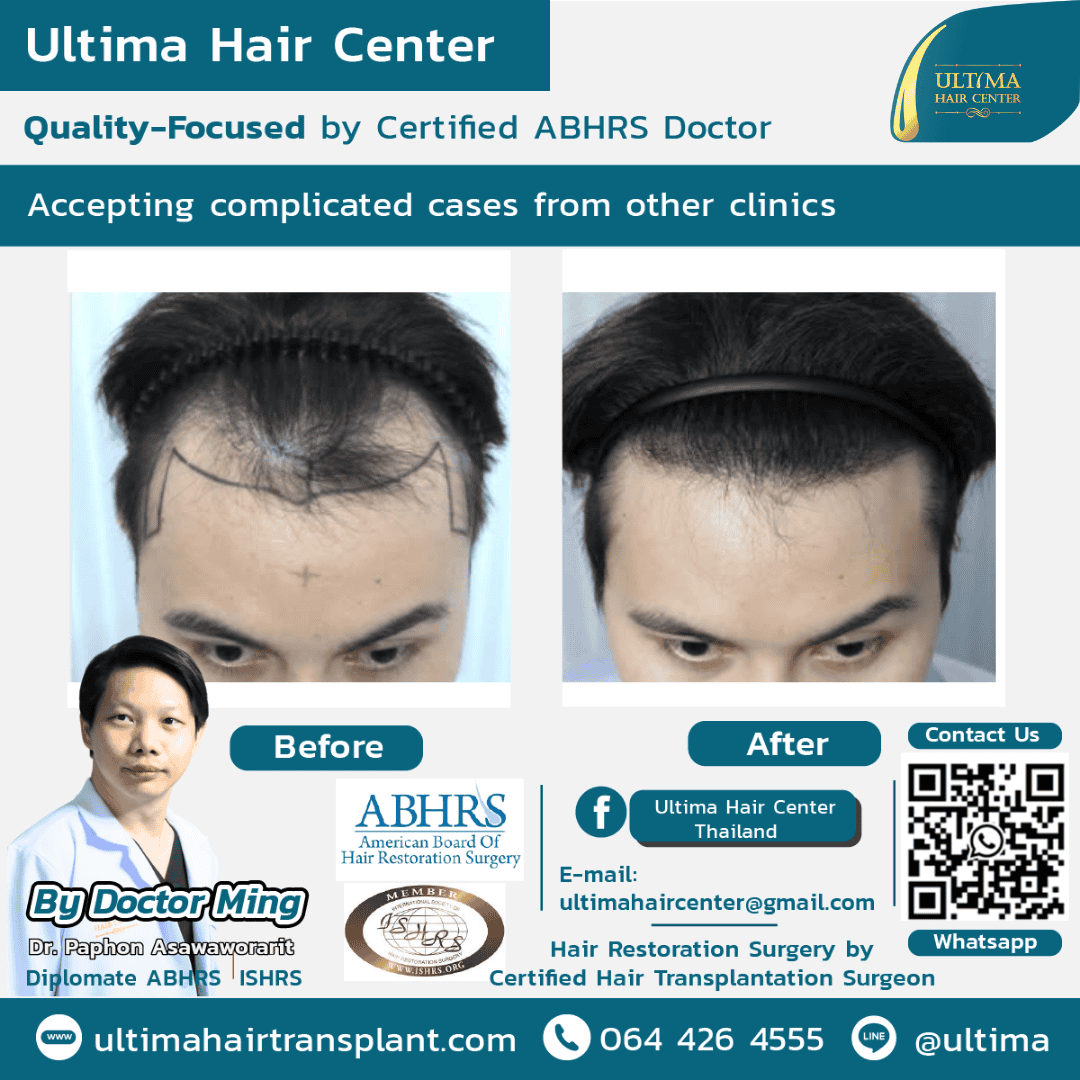 Board Certified Hair Transplant Reviews