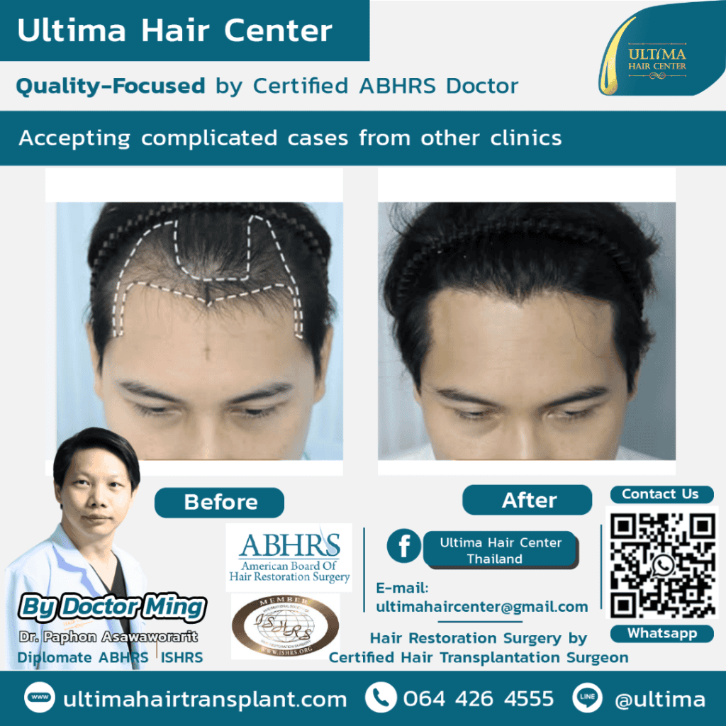 Board Certified Hair Transplant Reviews