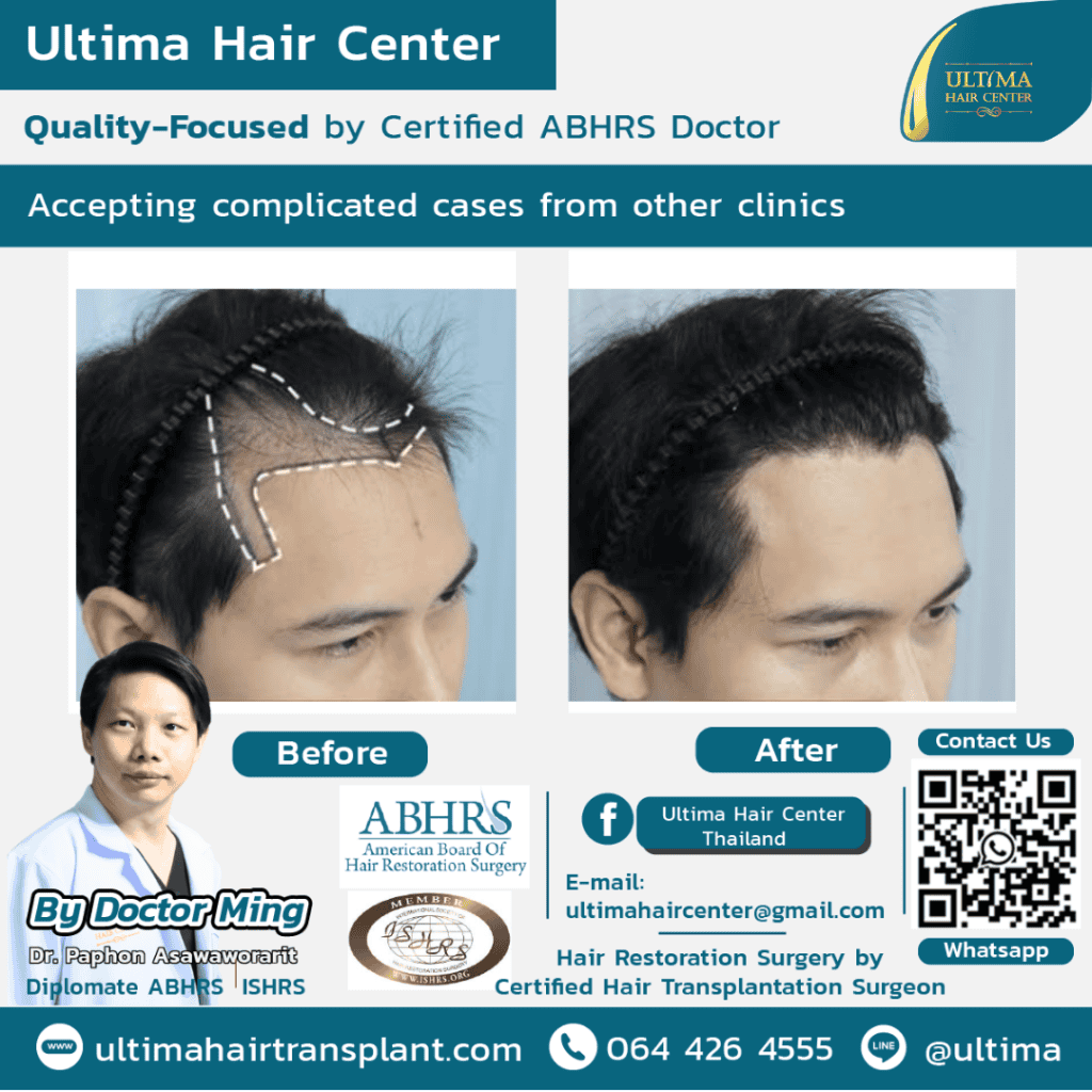 Board Certified Hair Transplant Reviews