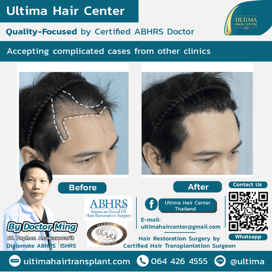 Hair Transplantation Doctors