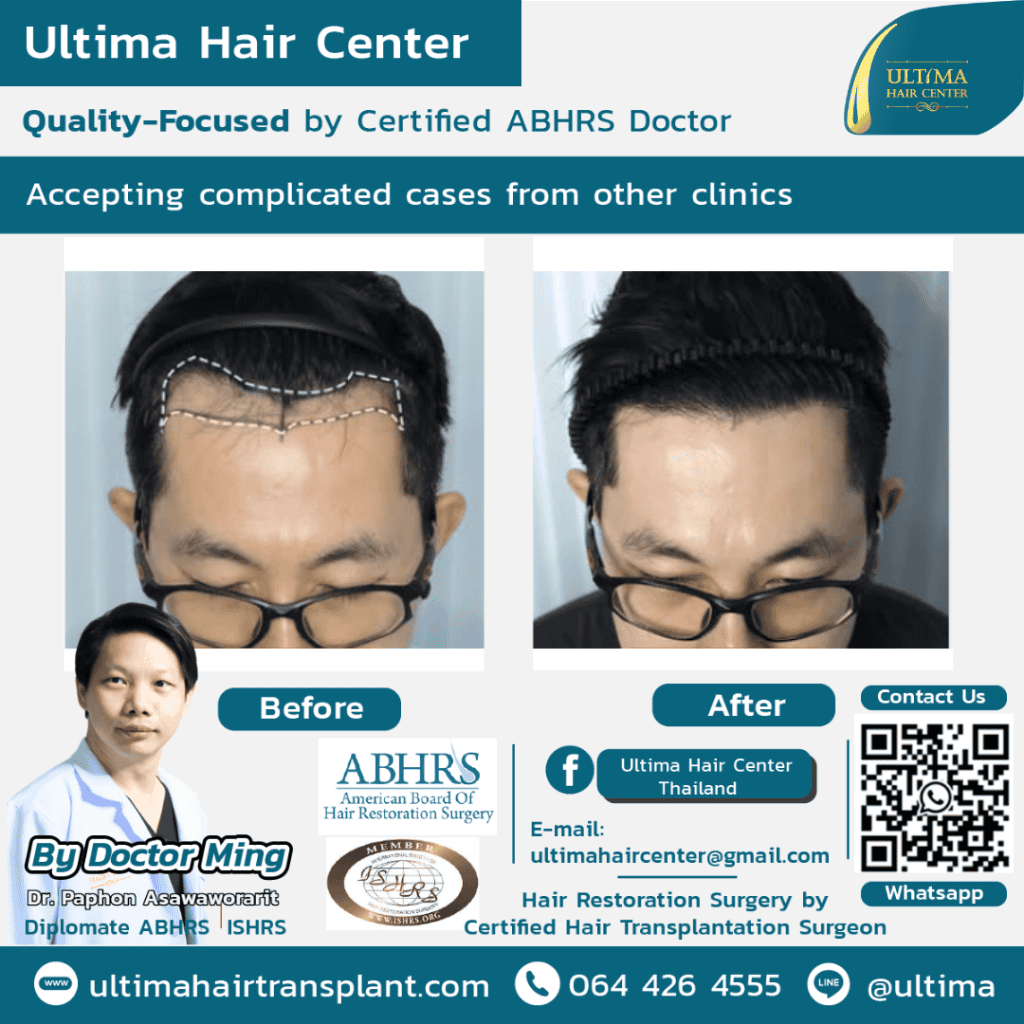 Hair transplant Thailand Bangkok