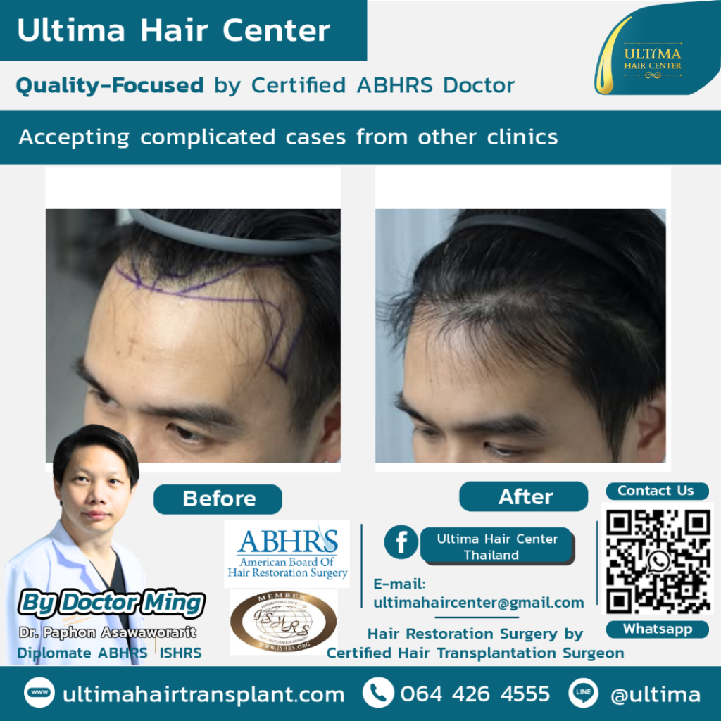 Is Thailand good for hair transplants