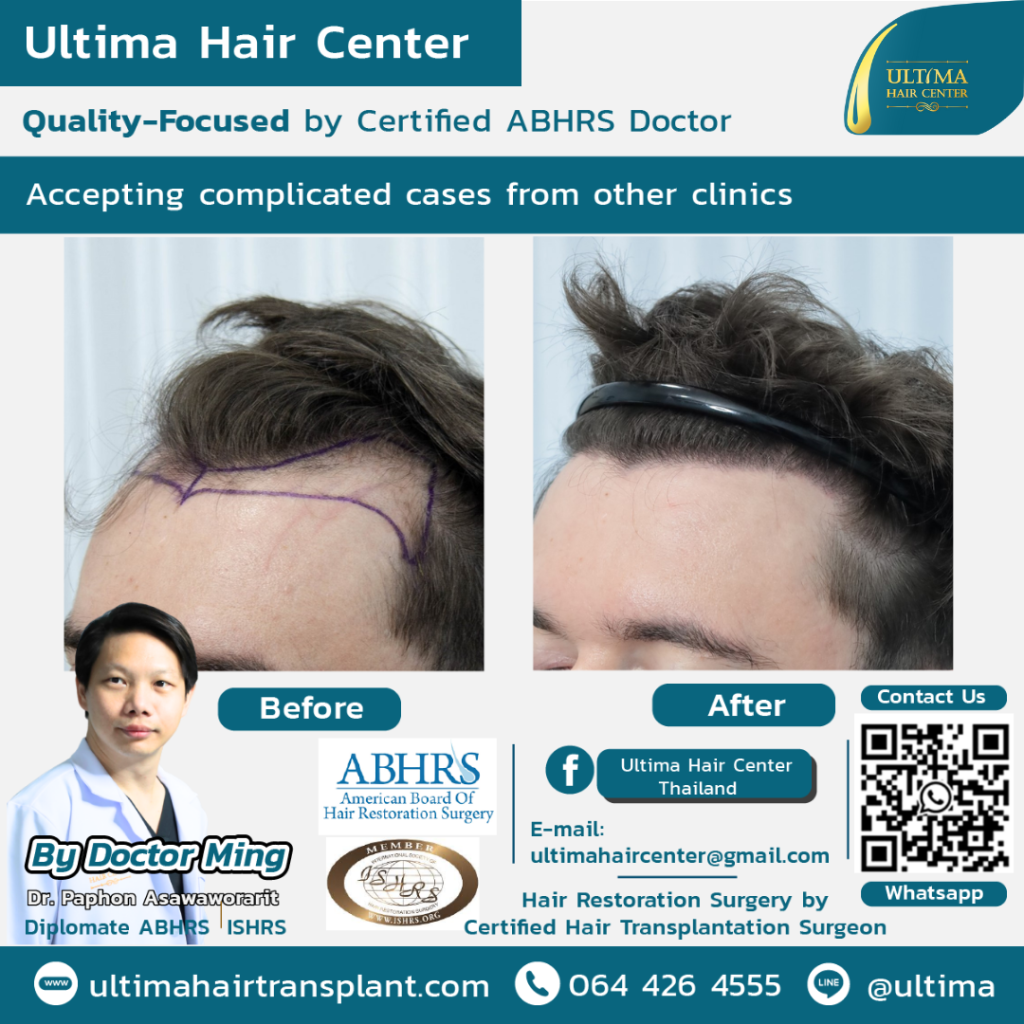 Hair Transplant Bangkok