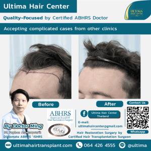 FUT hair transplant Thailand