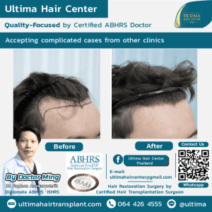 FUT hair transplant Thailand