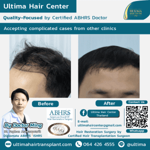 Medical tourism Thailand for hair transplant