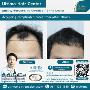 Medical tourism Thailand for hair transplant
