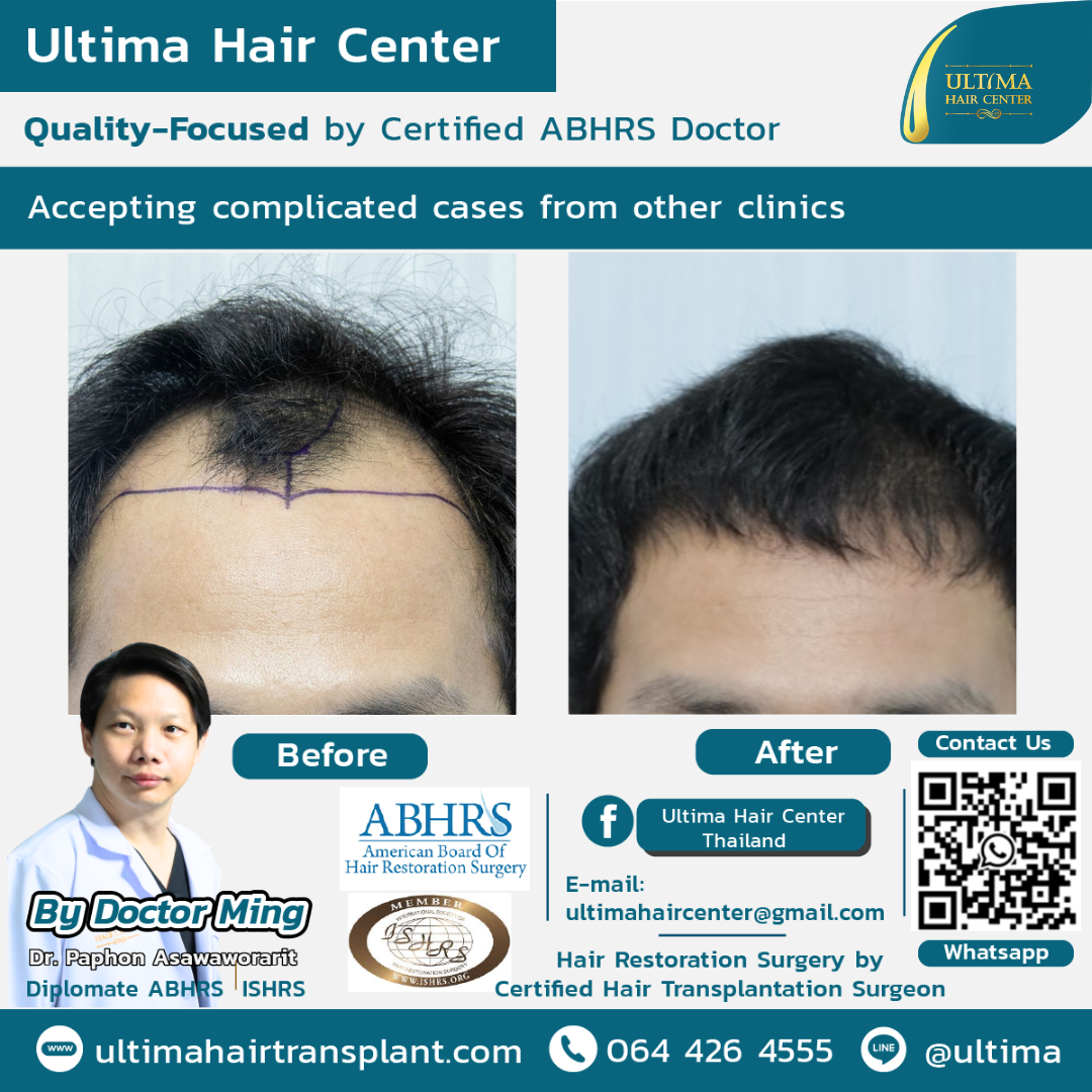 Hair Transplant Bangkok