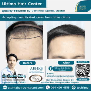FUE Hair Transplant Thailand