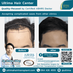 Medical tourism Thailand for hair transplant