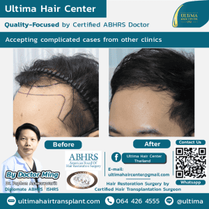 What Factors Influence the Total Cost of a Hair Transplant
