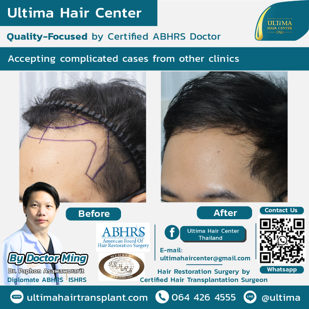 Is Thailand good for hair transplants