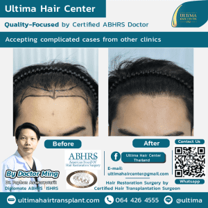 What are the main differences between hair transplant in Thailand and Turkey
