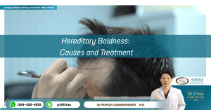 Hereditary Baldness Causes and Treatment