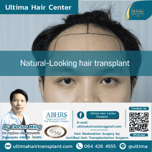 Natural-Looking hair transplant