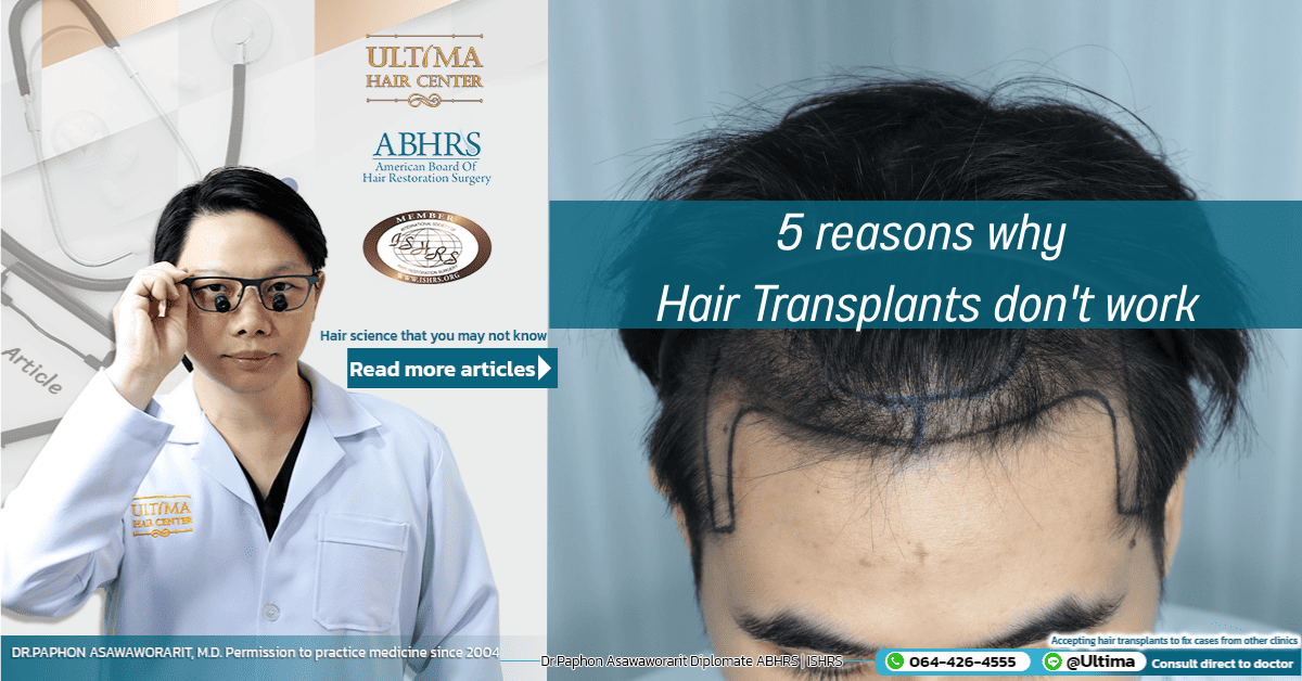 5 reasons why hair transplants don't work - Ultima Hair Transplant Thailand