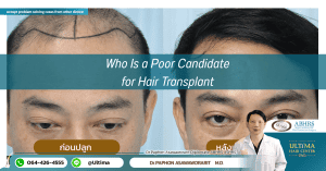 Who Is a Poor Candidate for Hair Transplant