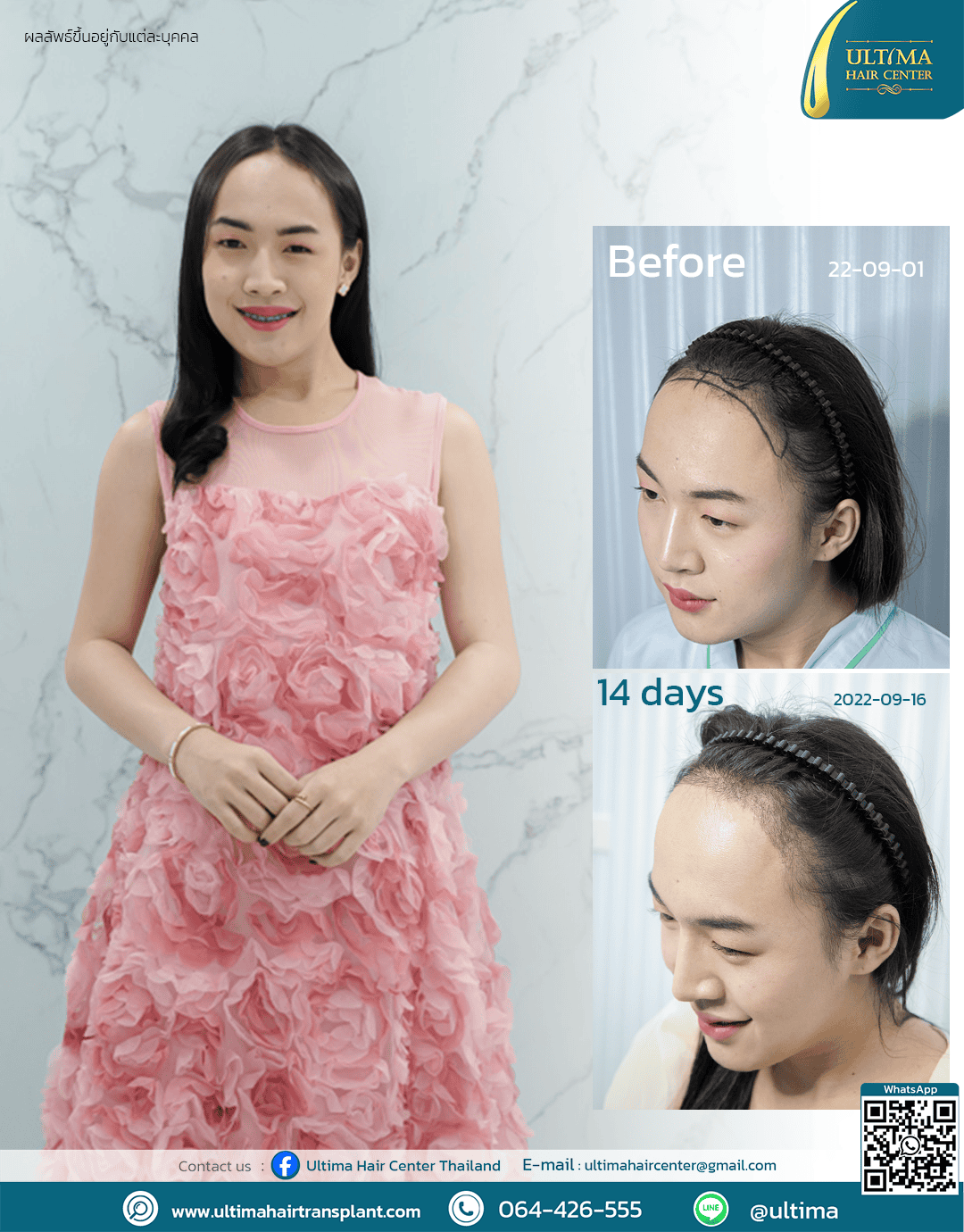 LGBT Hair transplant