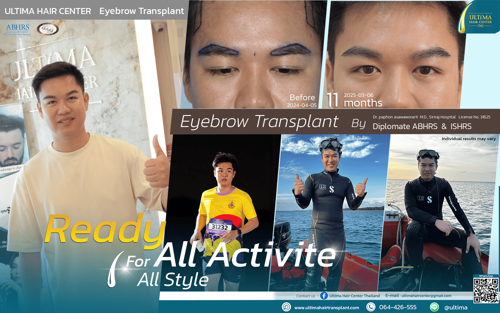 What is an Eyebrow Transplant