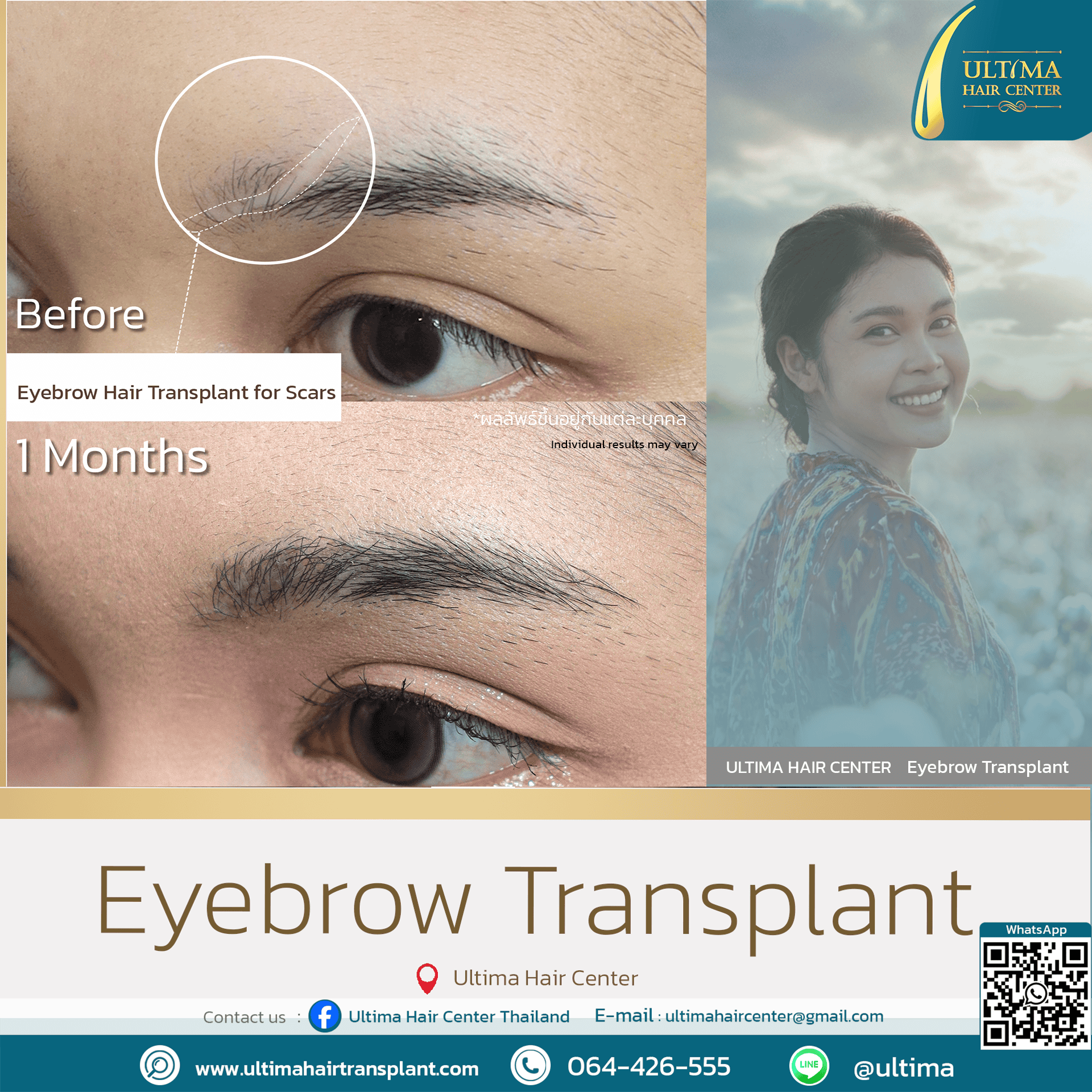 What is an Eyebrow Transplant