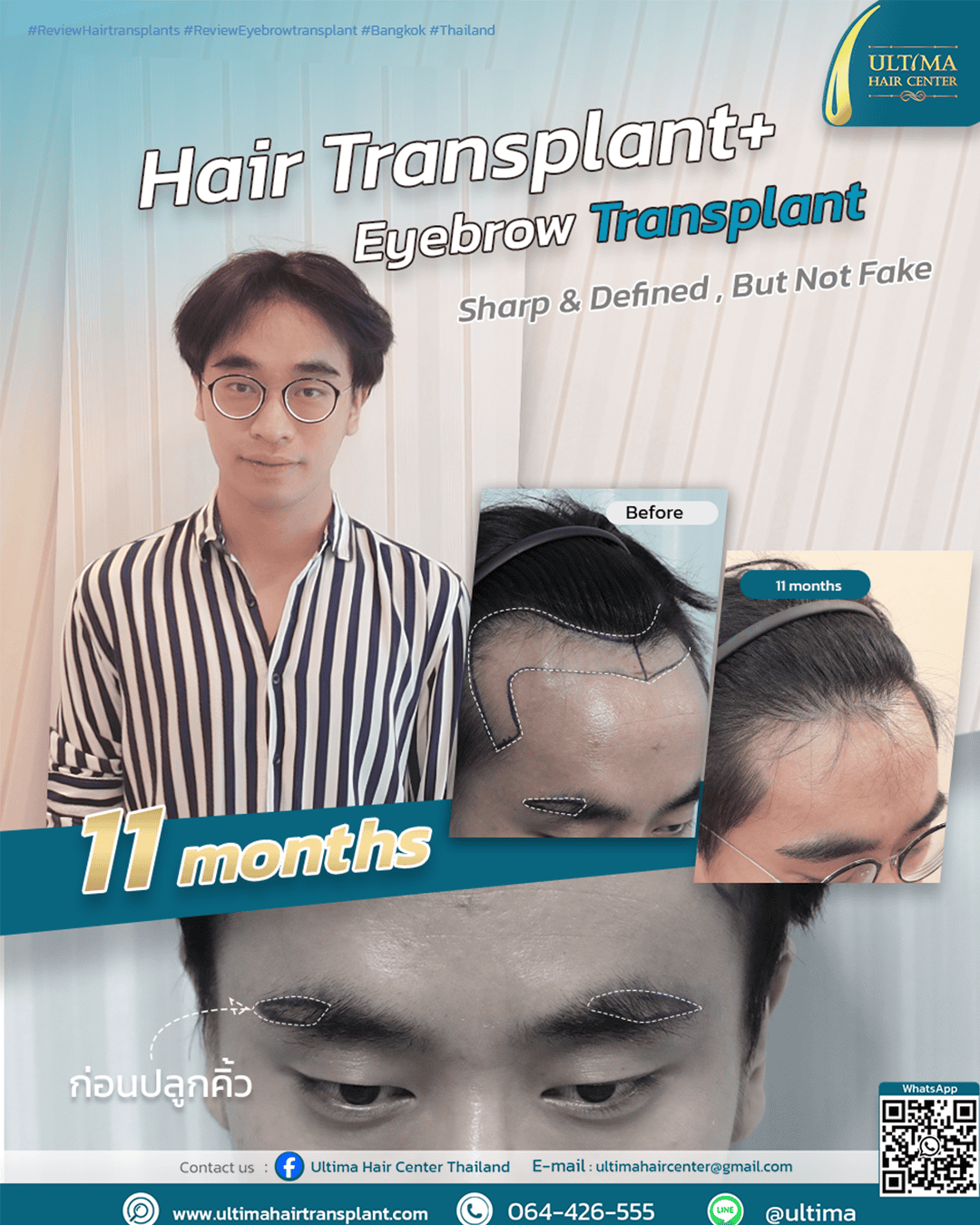 eyebrow hair transplant