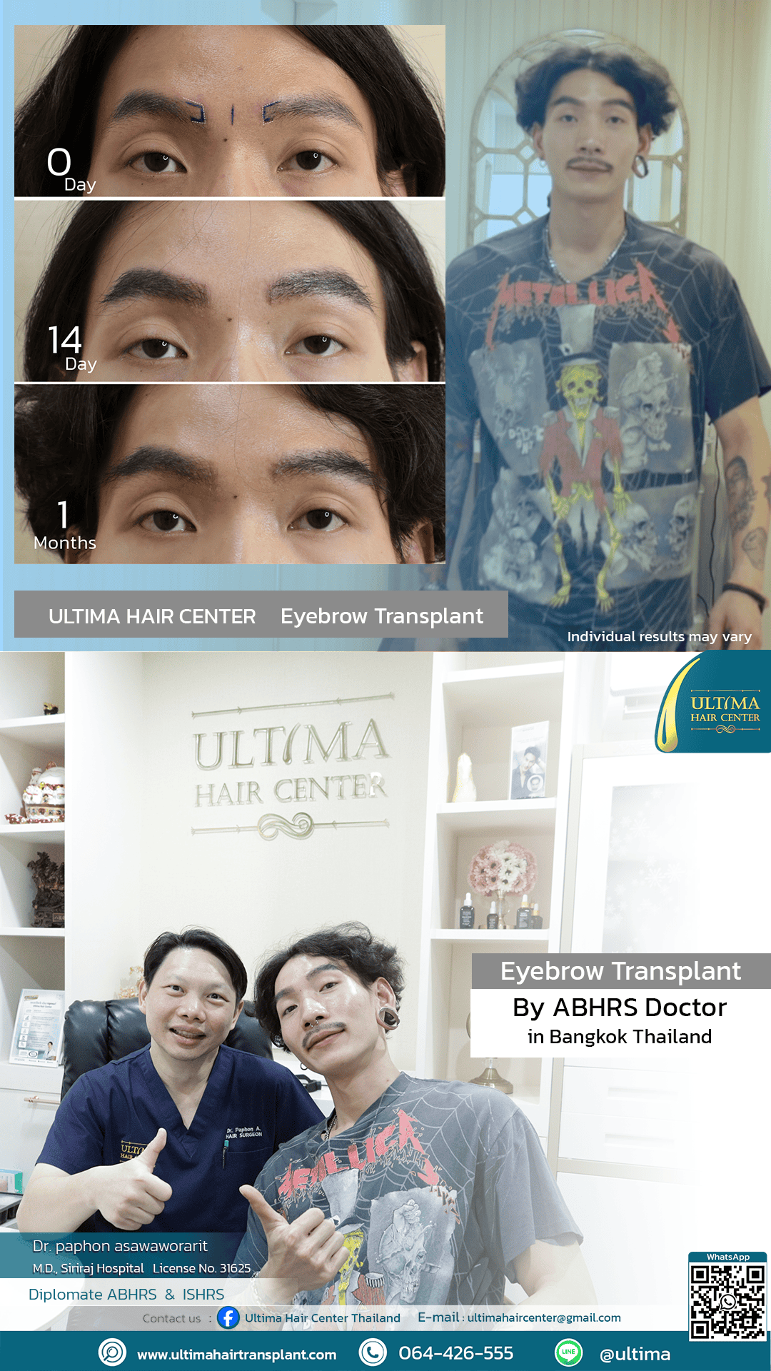 Who is Suitable for Eyebrow Transplantation