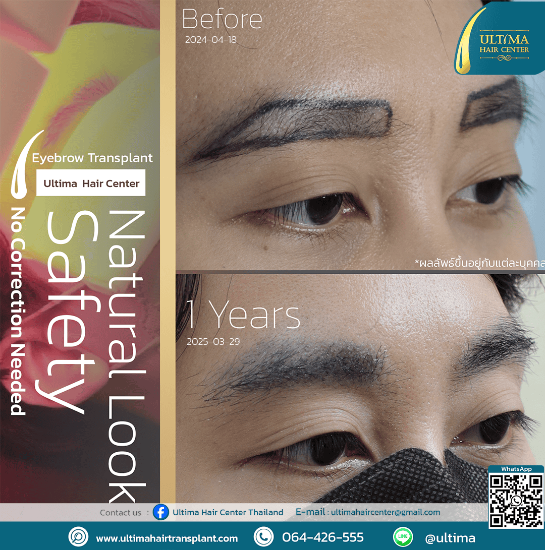 Who is Suitable for Eyebrow Transplantation