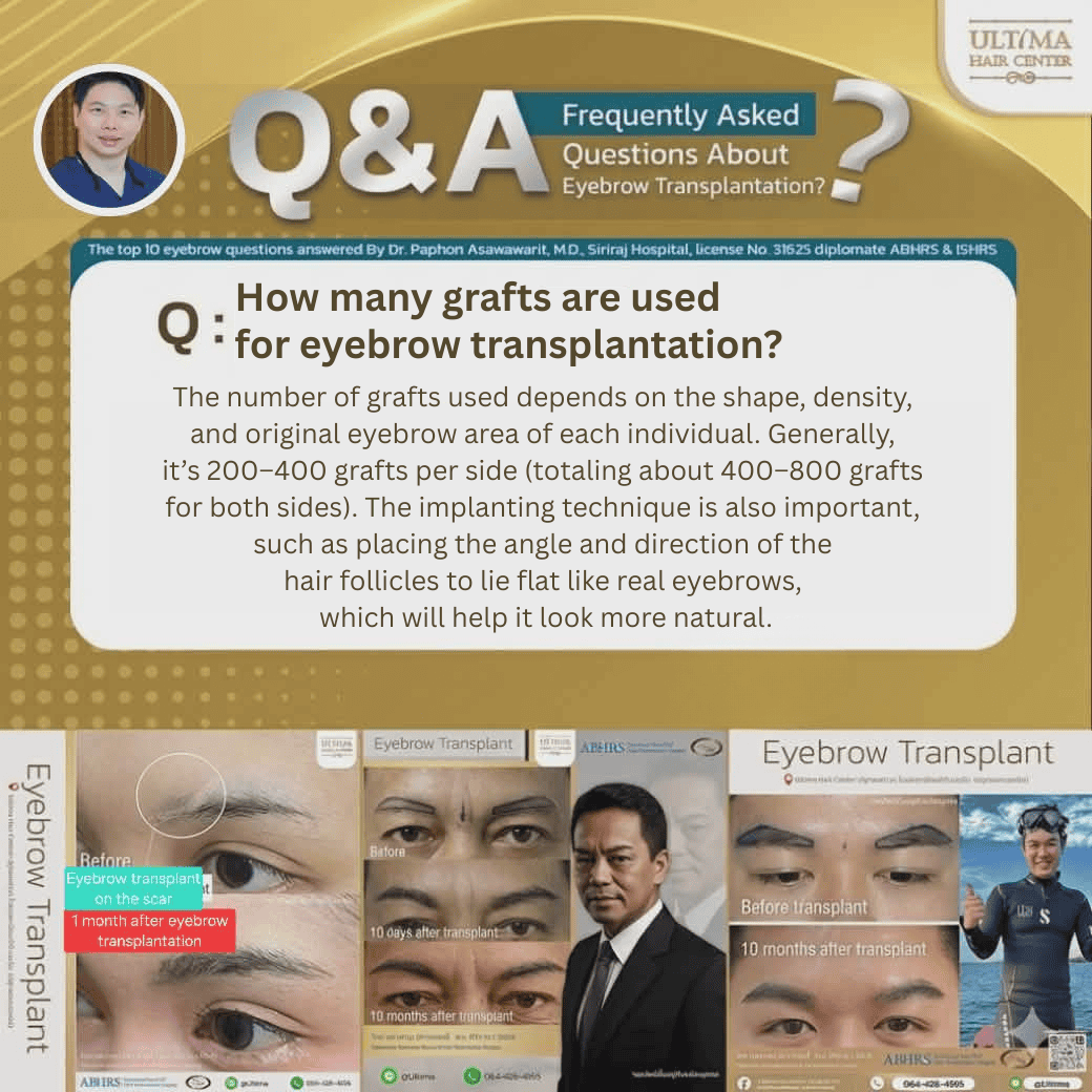 eyebrow hair transplant