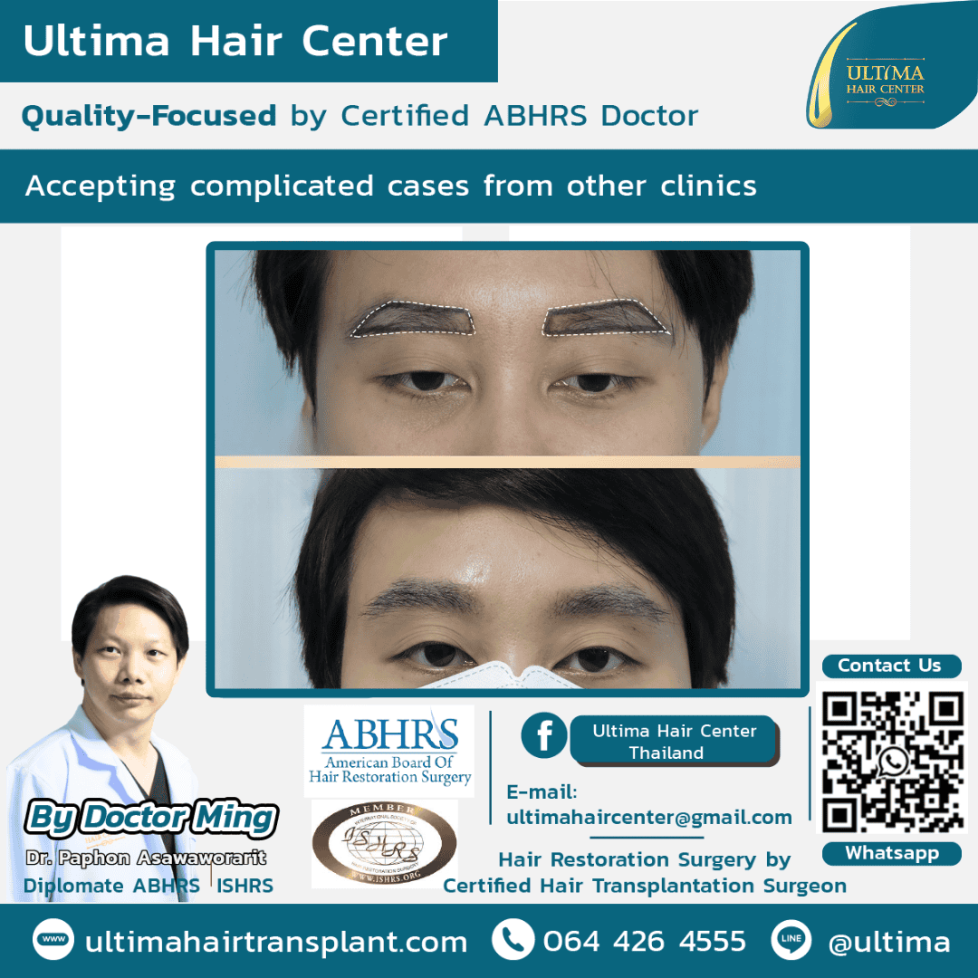 eyebrow hair transplant7