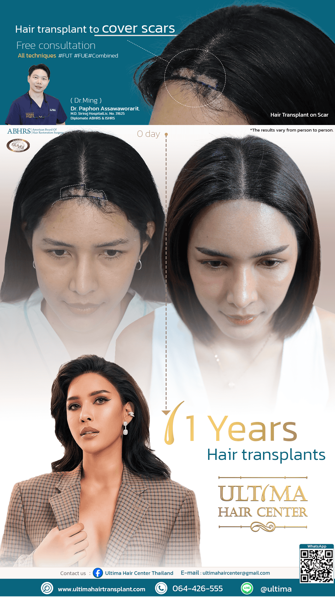 Where Can Women Have Hair Transplants