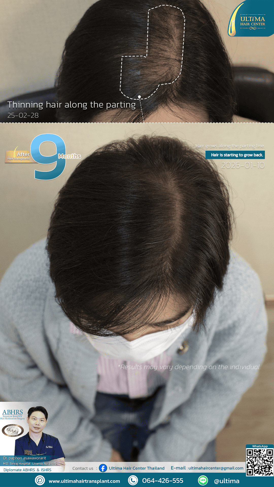 femalehairtransplant