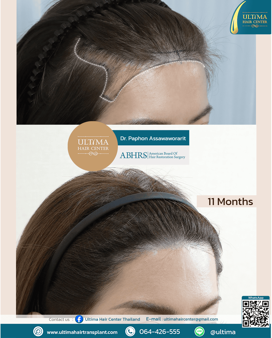 femalehairtransplant