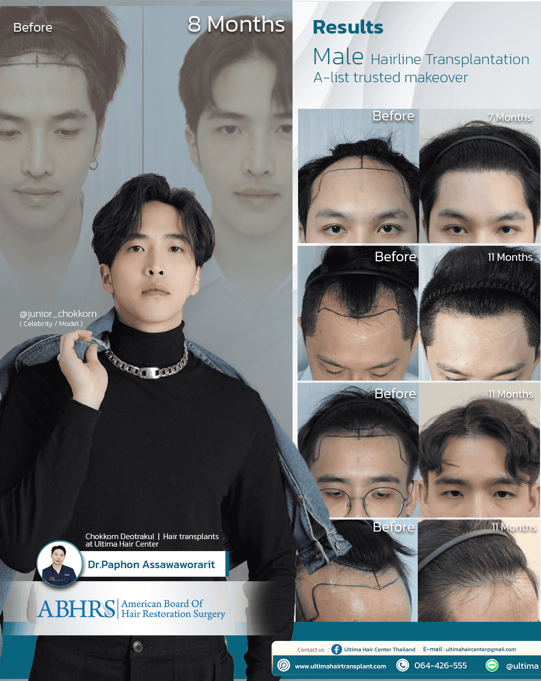 man hair transplant