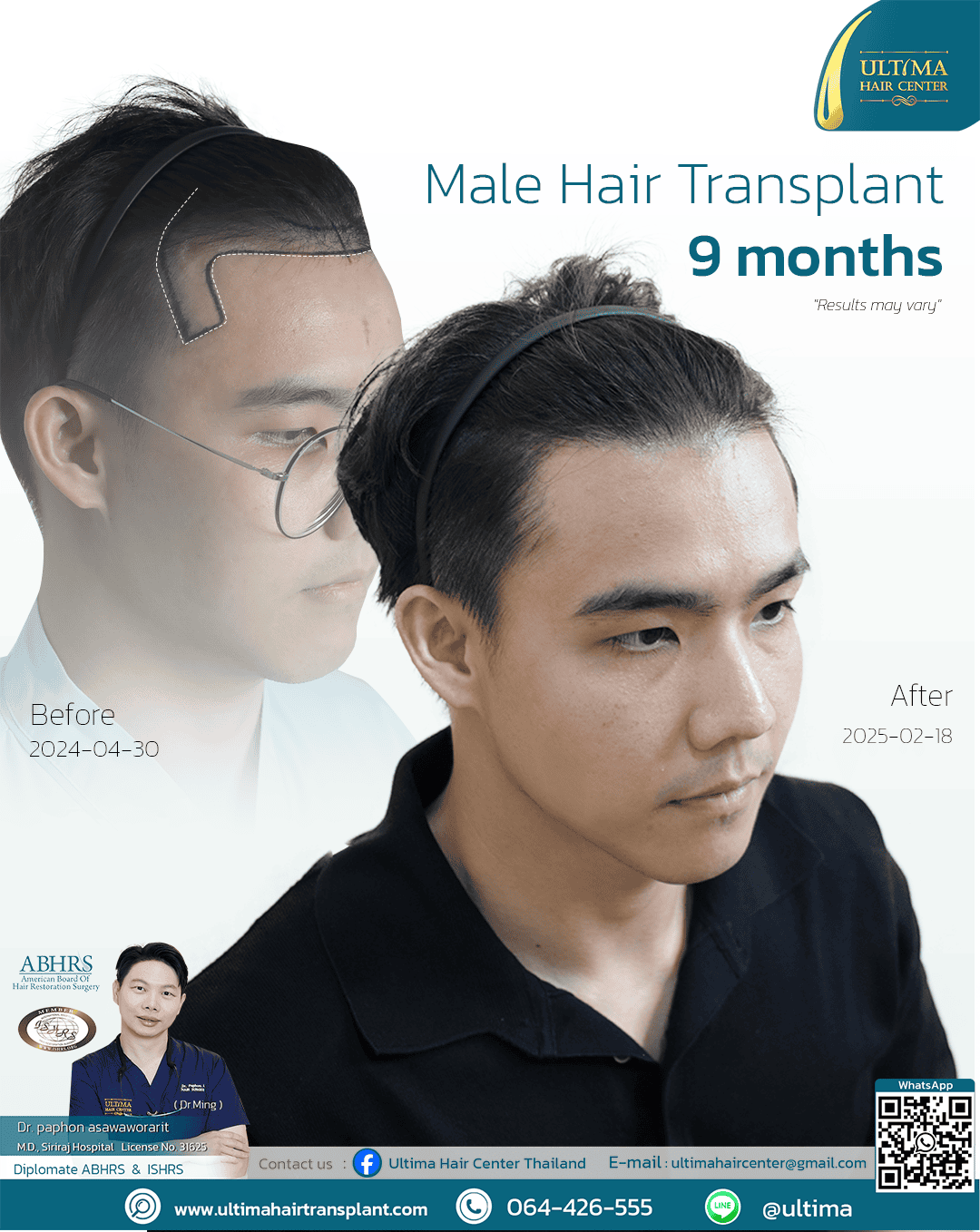 man hair transplant