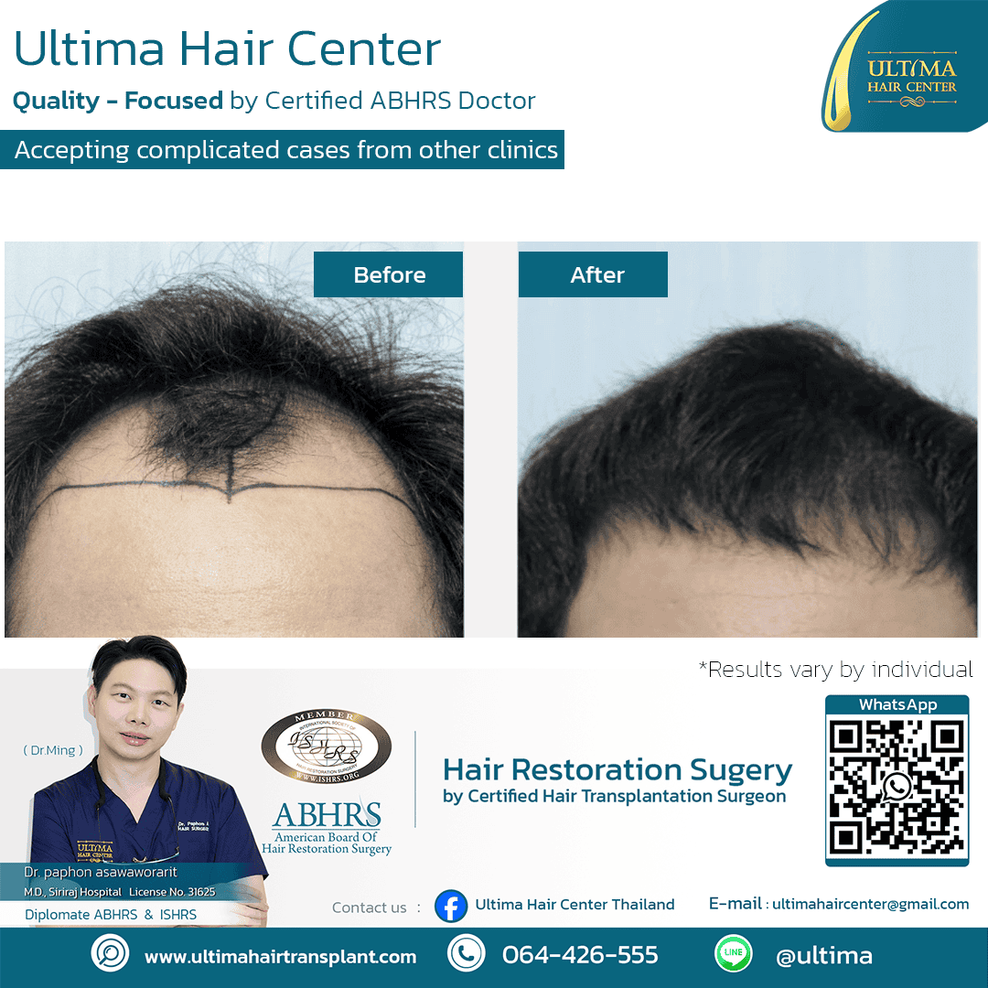 man hair transplant1