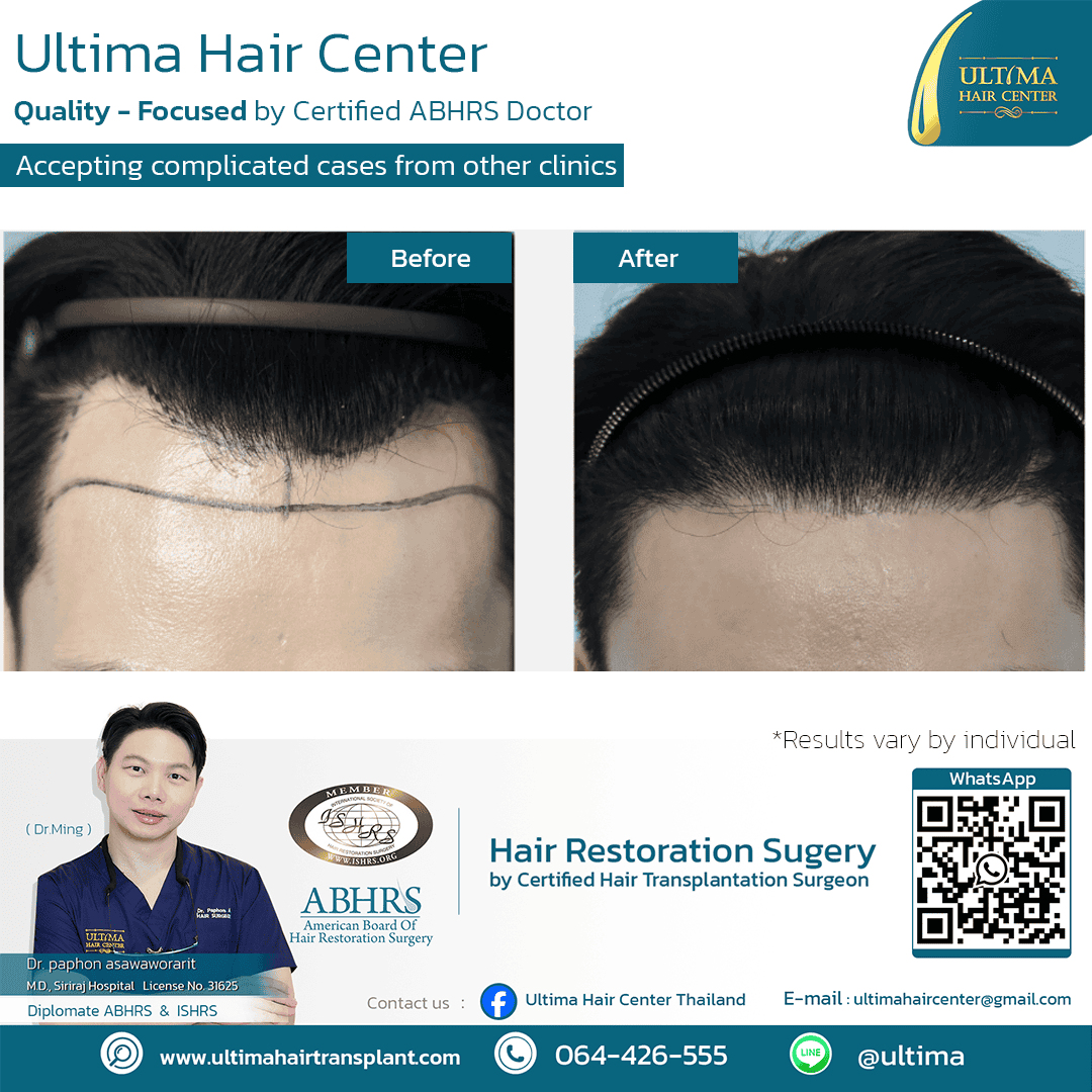 man hair transplant
