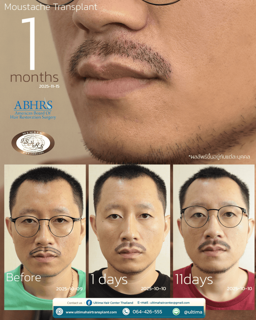 mustachetransplant