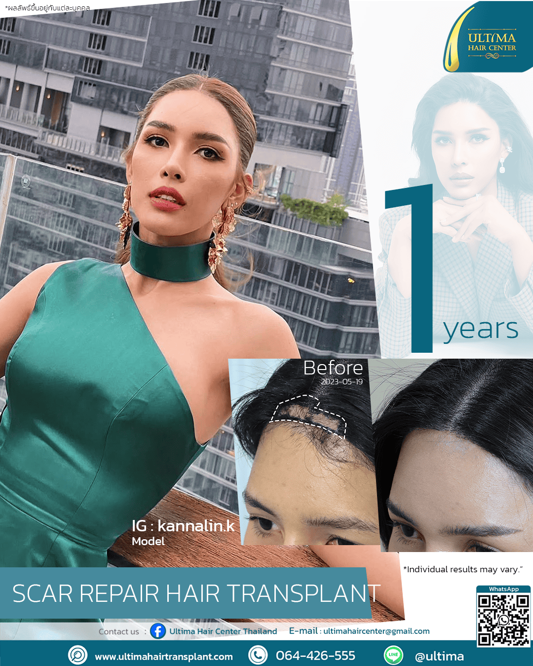 scar repair hair transplant