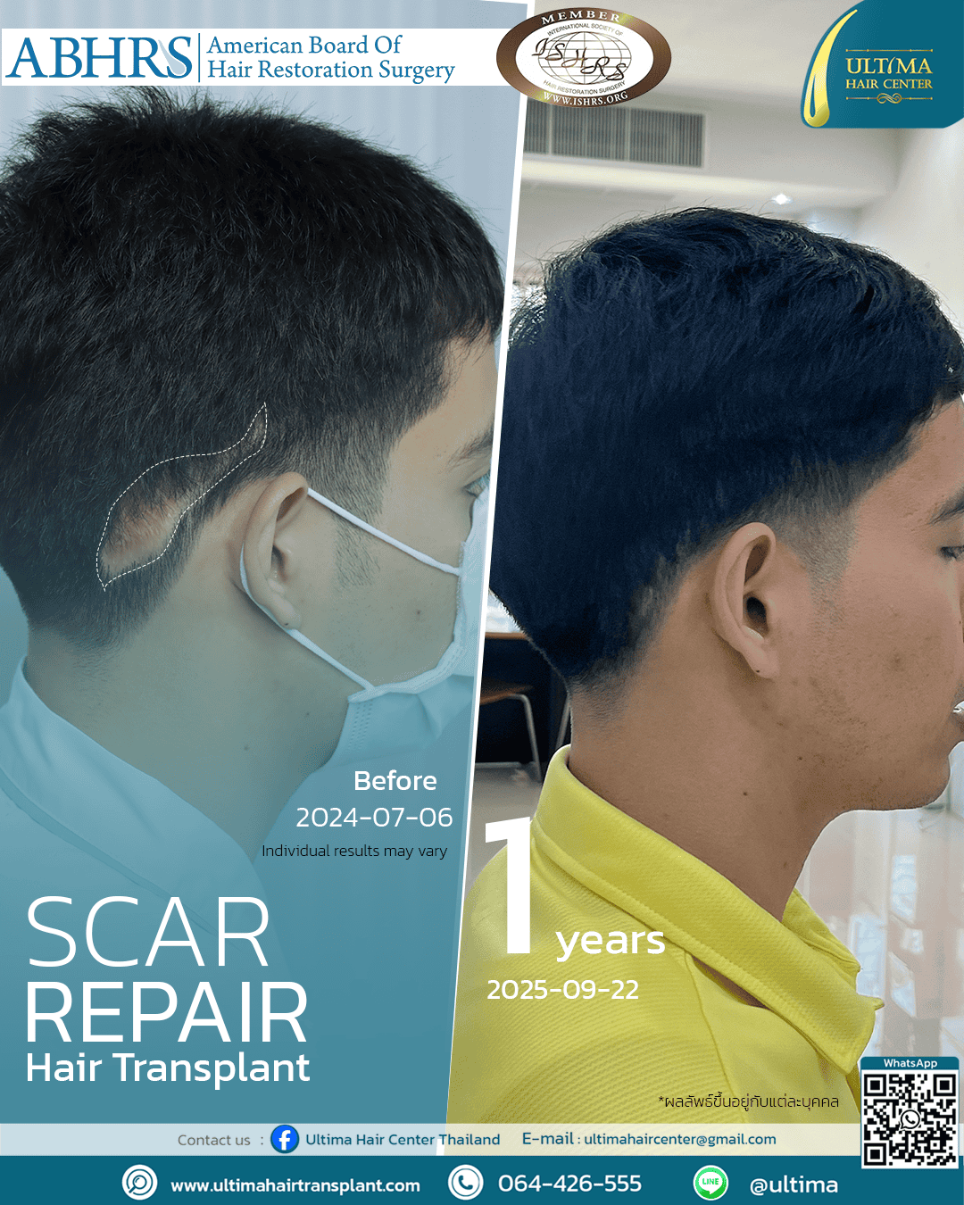 scar repair hair transplant
